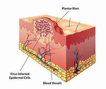 Image result for Wart Cross Section