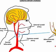 Image result for Occlusion and Stenosis of Left Carotid Artery
