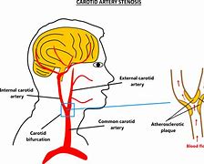 Image result for Carotid and Vertebral Arteries