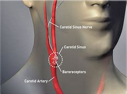 Image result for Carotid Artery Inflammation Neck Pain