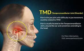 Image result for TMJ Joint Pain