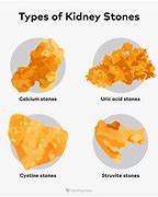 Image result for Four Types of Kidney Stones