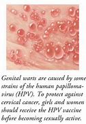 Image result for Female Genital Warts