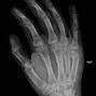 Image result for 4th Metatarsal Fracture Right Hand