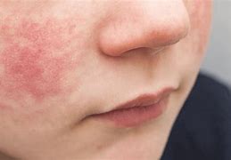 Image result for Fifth Disease and Cough