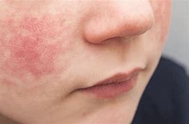 Image result for Early Symptoms of Fifth Disease
