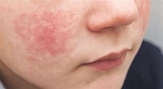 Image result for Fifth Disease Rash Treatment