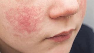 Image result for Fifth Disease