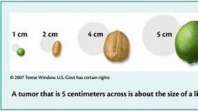 Image result for How Big Is 6 Cm Tumor