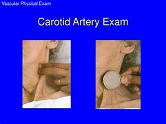 Image result for Carotid Artery Bruit