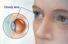 Image result for Blurry Vision with Cataracts
