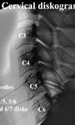 Image result for Lumbar and Cervical Discography