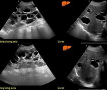 Image result for Renal Cyst Radiology