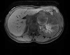 Image result for Adrenal Tumor