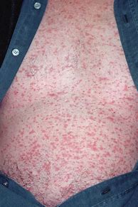Image result for Rash From Nickel Allergy