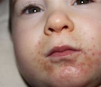 Image result for Rash around Mouth Child
