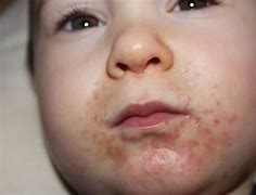 Image result for Food Allergy around Mouth in Pediatric