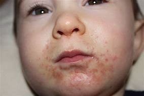 Image result for Food Allergy Rash in Toddlers