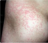 Image result for Fifrth Disease Rash
