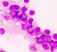 Image result for Acute Lymphoblastic Leukemia Patient