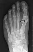 Image result for 4th Metatarsal Fracture Left Foot