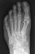 Image result for Third Metatarsal Fracture