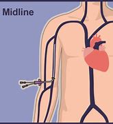 Image result for Midline Catheter Care