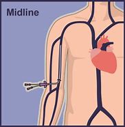Image result for Midline Catheter Which Vein