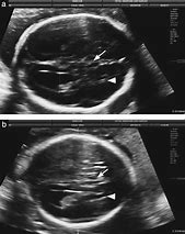 Image result for Corpus Callosum Agenesis Fetal Ultrasound