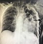 Image result for Chest Tube Connector