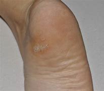 Image result for HPV Plantar Warts