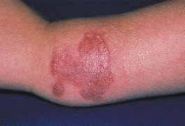Image result for Chronic Ulcer of Skin