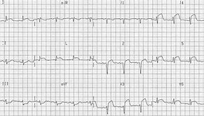 Image result for Anterior Myocardial Infarction ECG