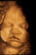 Image result for Cleft Lip and Palate Fetal Ultrasound
