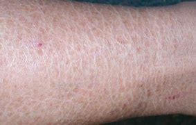 Image result for burn skin sensations