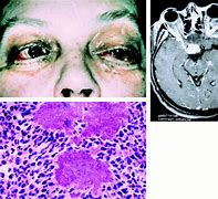 Image result for wctinomicosis
