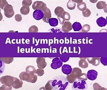Image result for Acute Lymphoblastic Leukemia Patient