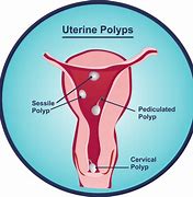 Image result for Fibroids and Polyps in Uterus