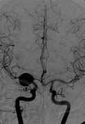Image result for Left ICA Occlusion
