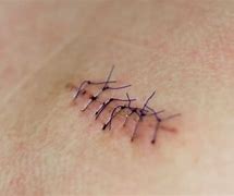 Image result for Mole Removal Stitches