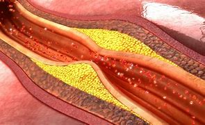 Image result for arterioesclerosis