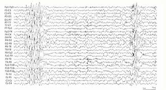 Image result for Spike-Wave Discharge EEG