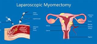 Image result for Uterine Fibroid Removal Surgery