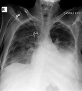 Image result for PICC X-ray Chest