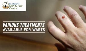 Image result for Ring Wart Treatment