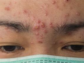Image result for Red Bumps On Face Not Pimples