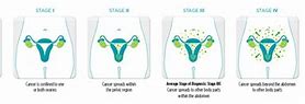 Image result for Ovarian Cancer Stages