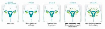 Image result for Staging of Ovarian Carcinoma
