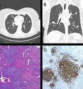 Image result for 6 mm Nodule in Lung