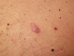 Image result for Lump Under Skin On Stomach